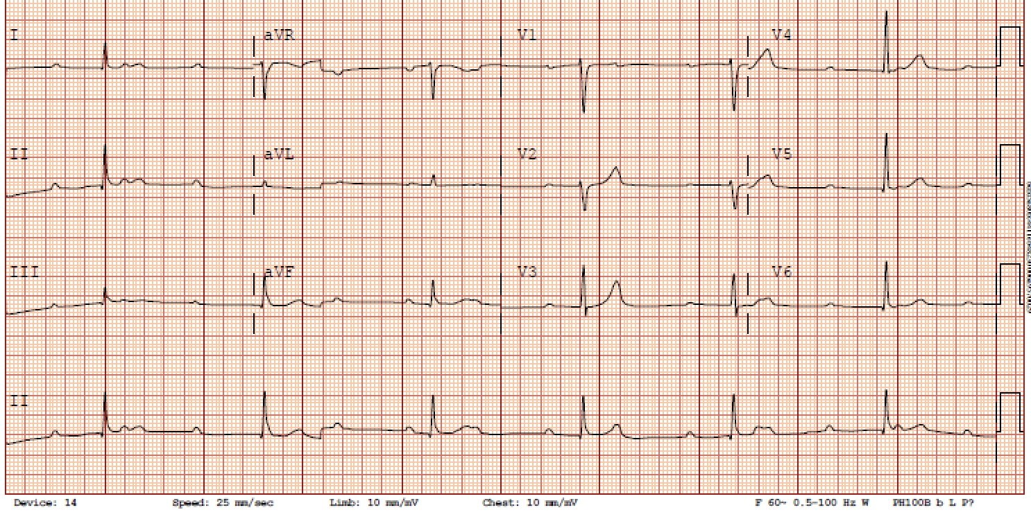Thirddegree heart block secondary to Lyme carditis British Columbia